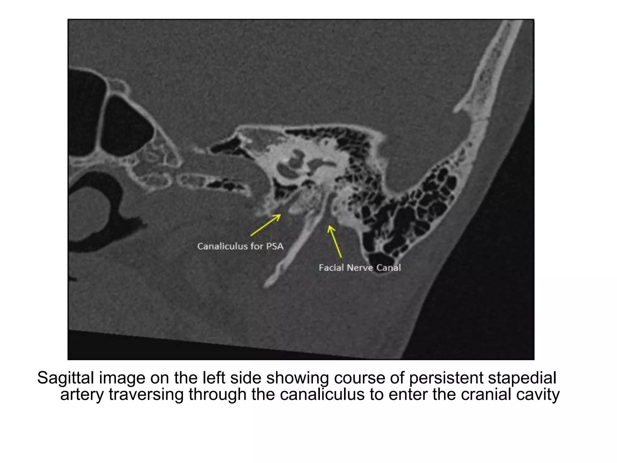 Ica Radiopaedia Interventional Neuroradiology: Anatomy of the internal carotid artery ...