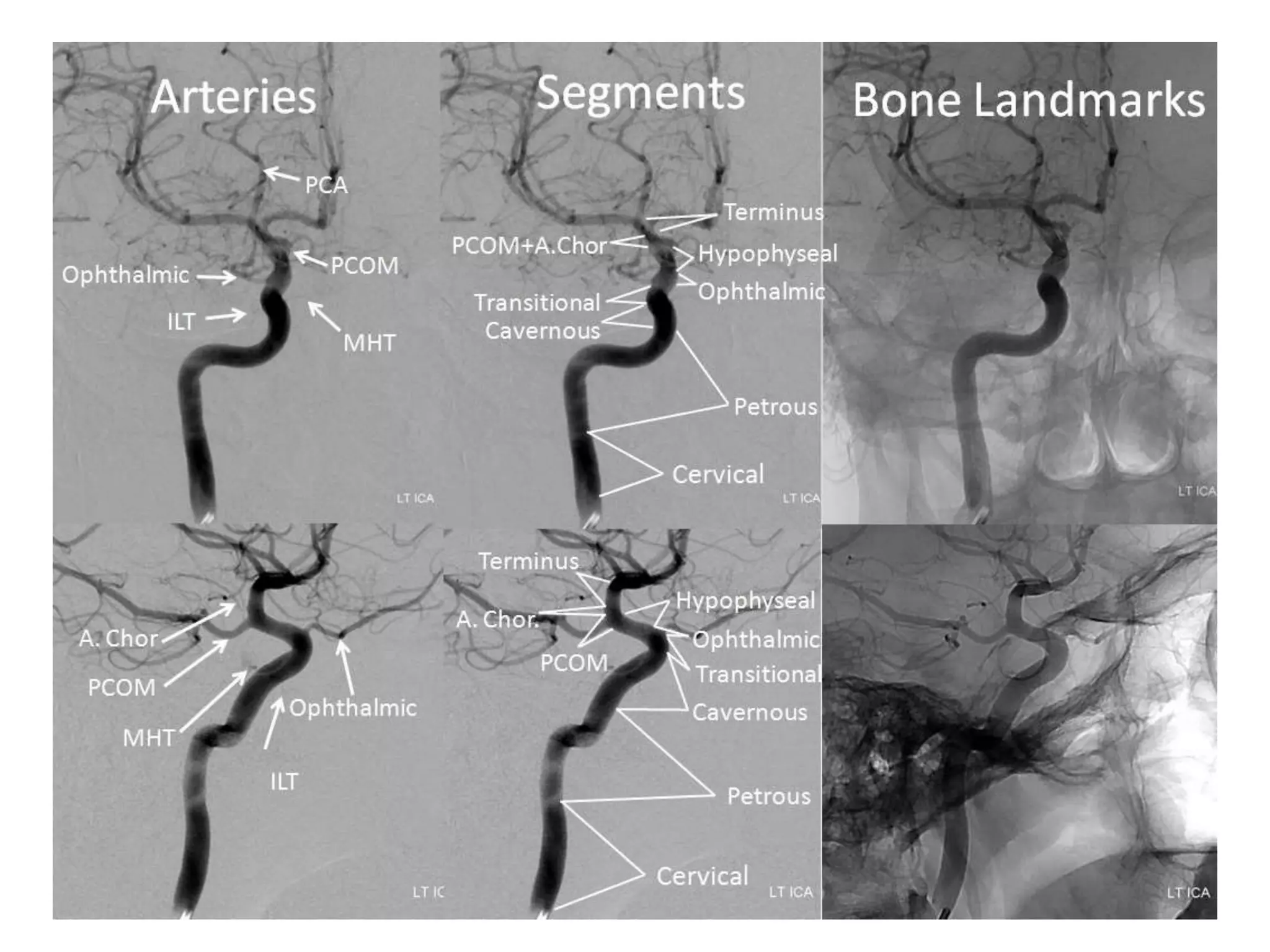 Ica Path Interventional Neuroradiology: Anatomy of the internal carotid artery ...