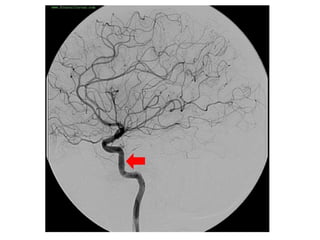 Interventional Neuroradiology: Anatomy of the internal carotid artery ...