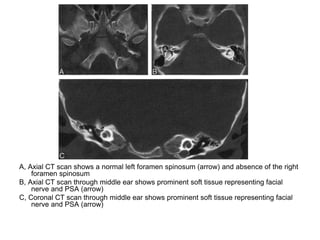 Interventional Neuroradiology: Anatomy of the internal carotid artery ...