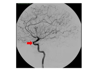 Ica Path The Path Of The Internal Carotid Artery Clinical Anatomy
