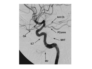Interventional Neuroradiology: Anatomy of the internal carotid artery ...