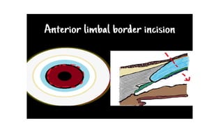 Limbus Lab ANATOMY LIMBUS comprehensive ophthalmology .pptx
