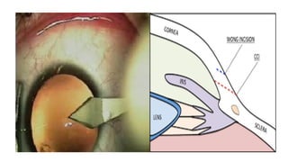 Limbus Lab ANATOMY LIMBUS comprehensive ophthalmology .pptx