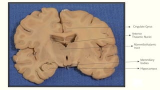 Hippocampus
Mammillary
bodies
Mammillothalamic
tract
Anterior
Thalamic Nuclei
Cingulate Gyrus
 