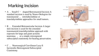 Simple Flank Incision Anatomy Middle Cranial Fossa Kelvin.pptx