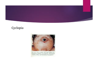 Anatomy , development n embrology of eye | PPT