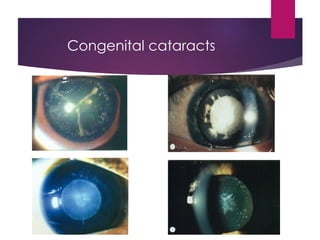 Anatomy , development n embrology of eye | PPT