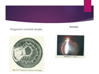 Anatomy , development n embrology of eye | PPT