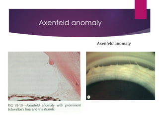 Anatomy , development n embrology of eye | PPT