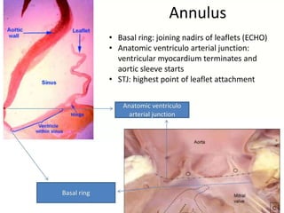 Anatomy Of Aortic Valve- Dr Garv Ameta.pptx