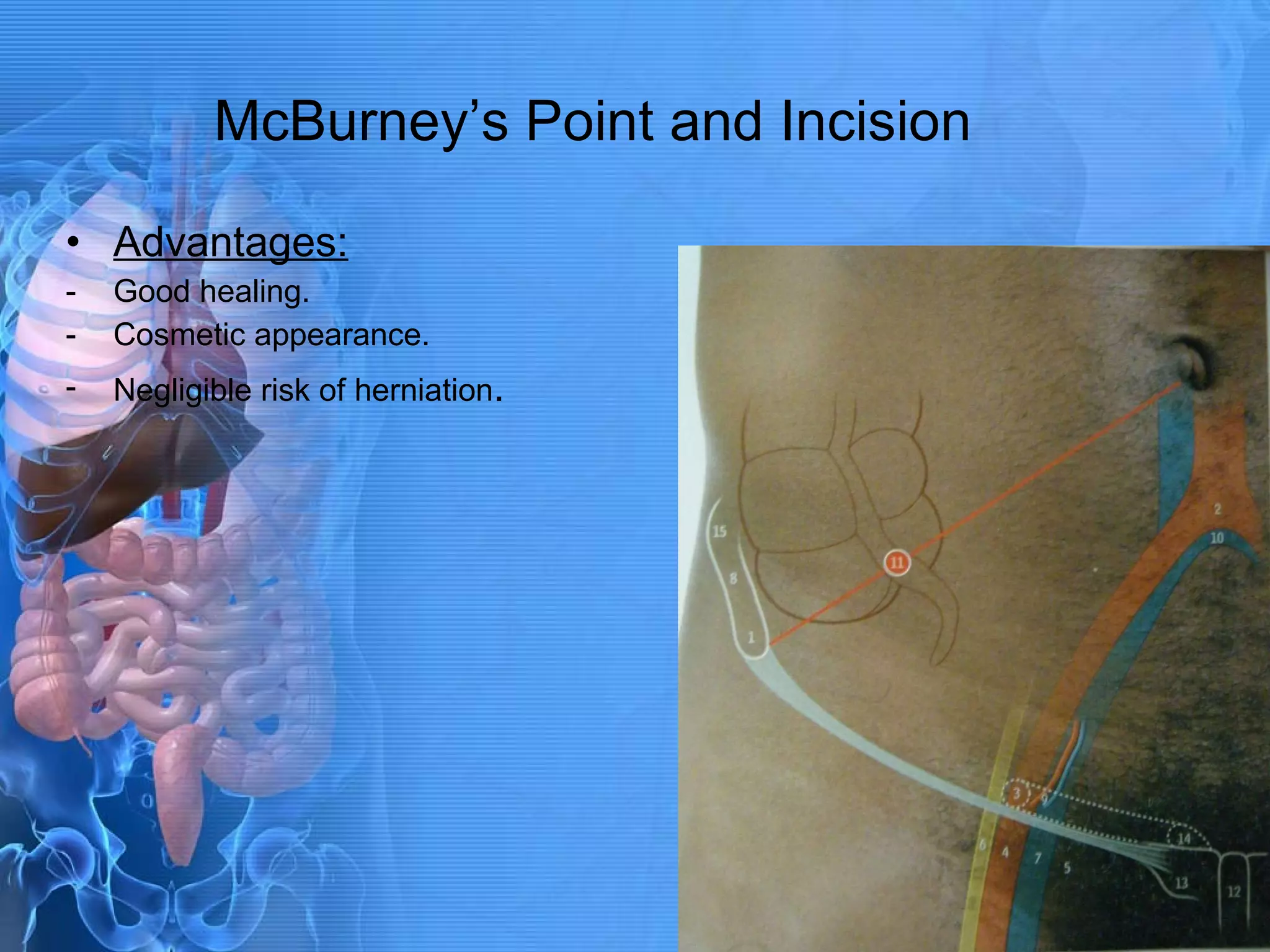 McBurney’s Point and Incision Advantages: Good healing. Cosmetic appearance. Negligible risk of herniation . 