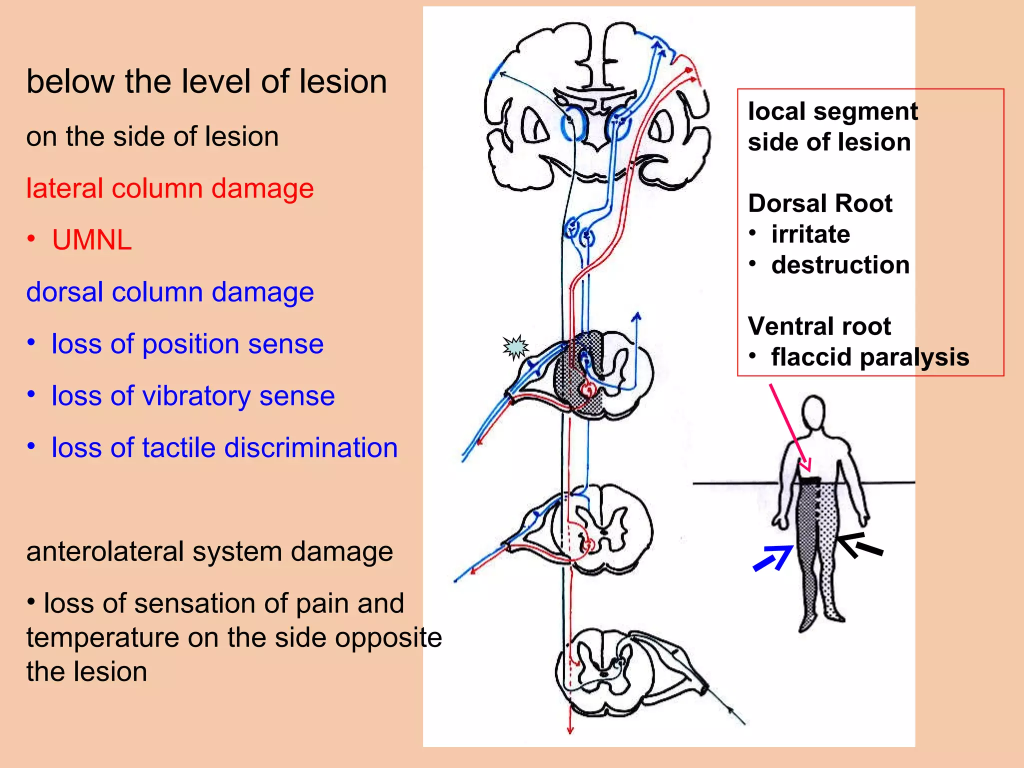 below the level of lesion on the side of lesion lateral column damage UMNL dorsal column damage loss of position sense loss of vibratory sense loss of tactile discrimination anterolateral system damage loss of sensation of pain and temperature on the side opposite the lesion local segment  side of lesion Dorsal Root irritate destruction Ventral root flaccid paralysis 