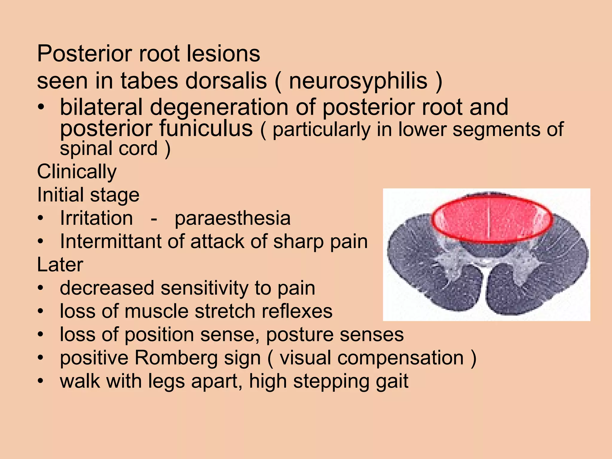 Posterior root lesions seen in tabes dorsalis ( neurosyphilis )  bilateral degeneration of posterior root and posterior funiculus  ( particularly in lower segments of spinal cord ) Clinically Initial stage Irritation  -  paraesthesia Intermittant of attack of sharp pain Later  decreased sensitivity to pain loss of muscle stretch reflexes loss of position sense, posture senses positive Romberg sign ( visual compensation )  walk with legs apart, high stepping gait 