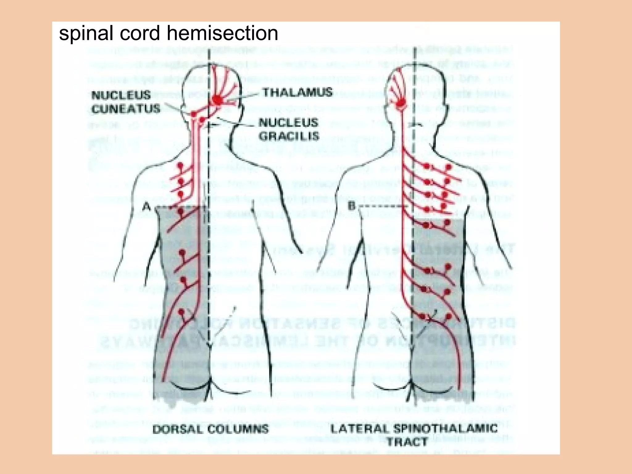 spinal cord hemisection 