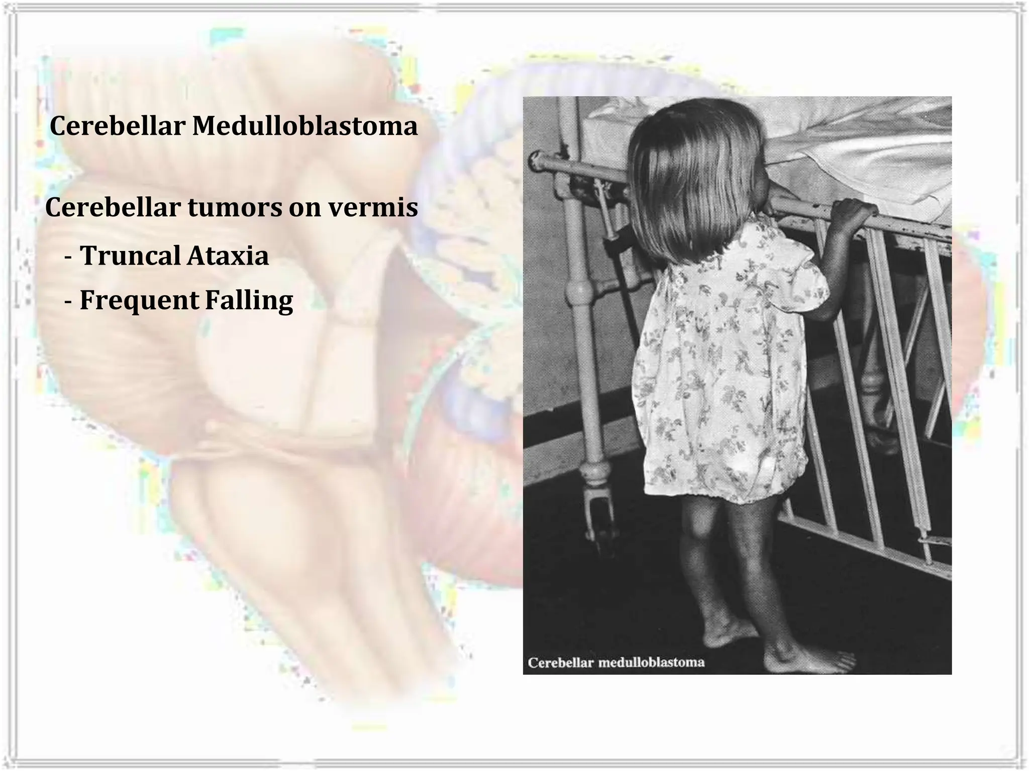 Cerebellar Medulloblastoma
Cerebellar tumors on vermis
- Truncal Ataxia
- Frequent Falling
 