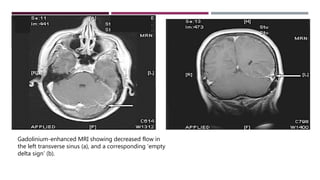 Delta Sign Mri Anatomy of cerebral veins | PPTX