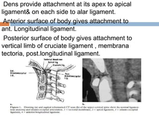 …Dens provide attachment at its apex to apical
ligament& on each side to alar ligament.
…Anterior surface of body gives at...