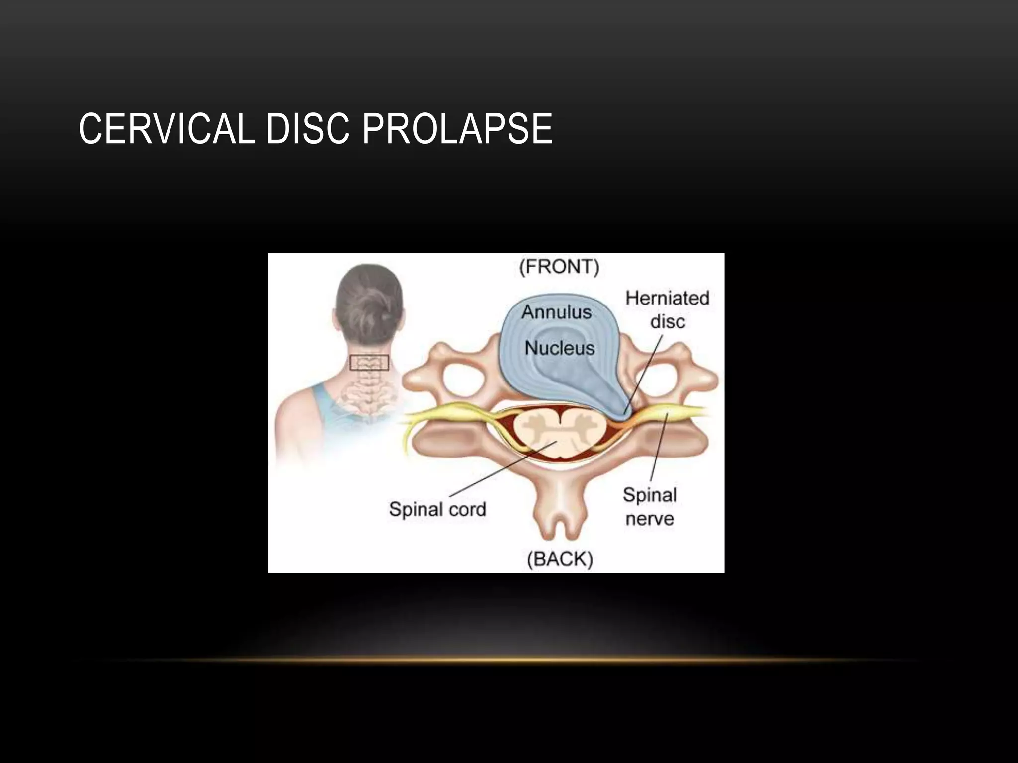 Cd Spine Example Anatomy of cervical spine | PPTX