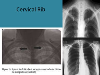 Right Complete Cervical Rib Anatomy of chest | PPTX