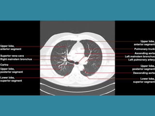 Anatomy of chest | PPTX