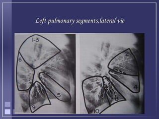 Left Promontory radiology anatomy of chest.ppt