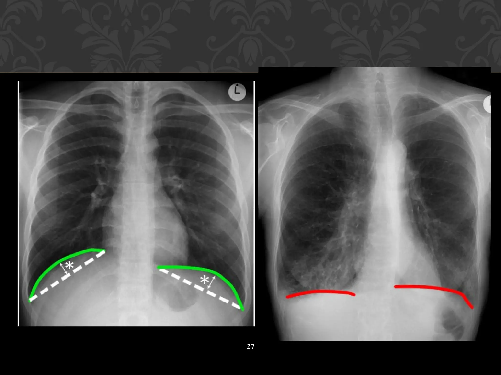 anatomy of chest in radiograph radiology.ppt