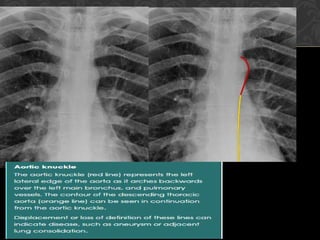 anatomy of chest in radiograph radiology.ppt
