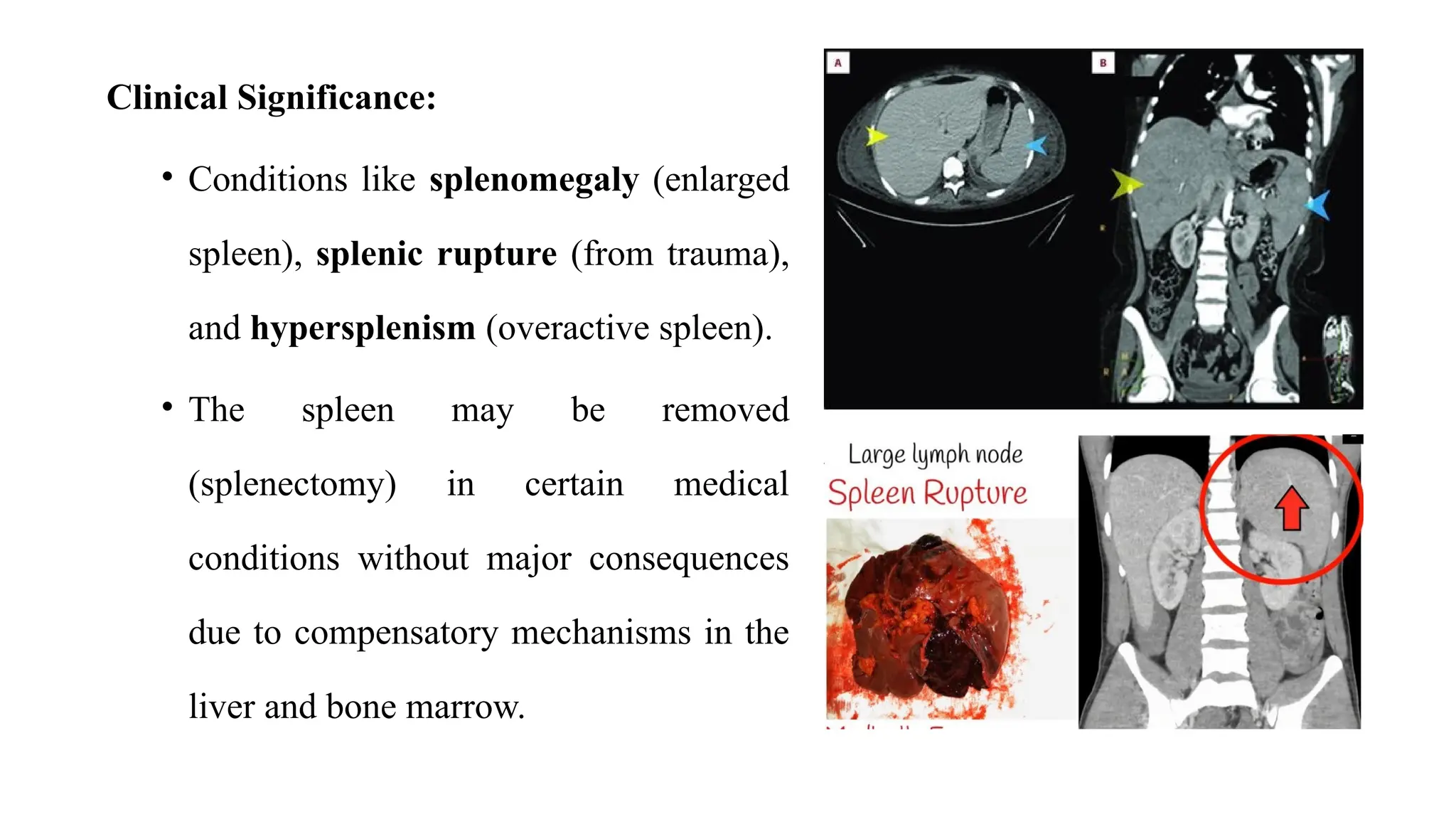 Spleen Rapture Anatomy of Digestive System, Liver, pancreas, and gallbladder .pptx