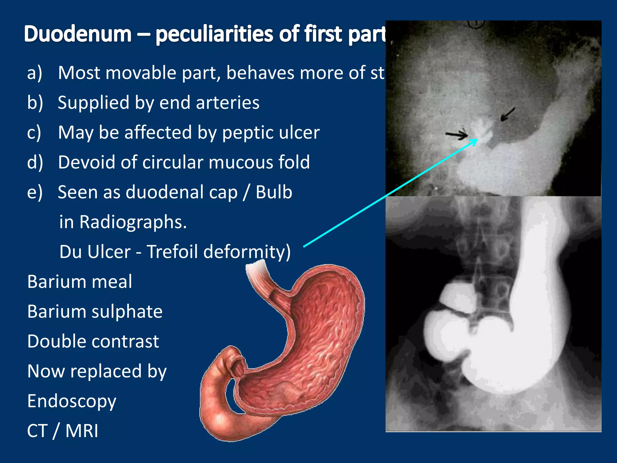 a) Most movable part, behaves more of stomach than duodenum
b) Supplied by end arteries
c) May be affected by peptic ulcer
d) Devoid of circular mucous fold
e) Seen as duodenal cap / Bulb
in Radiographs.
Du Ulcer - Trefoil deformity)
Barium meal
Barium sulphate
Double contrast
Now replaced by
Endoscopy
CT / MRI
 
