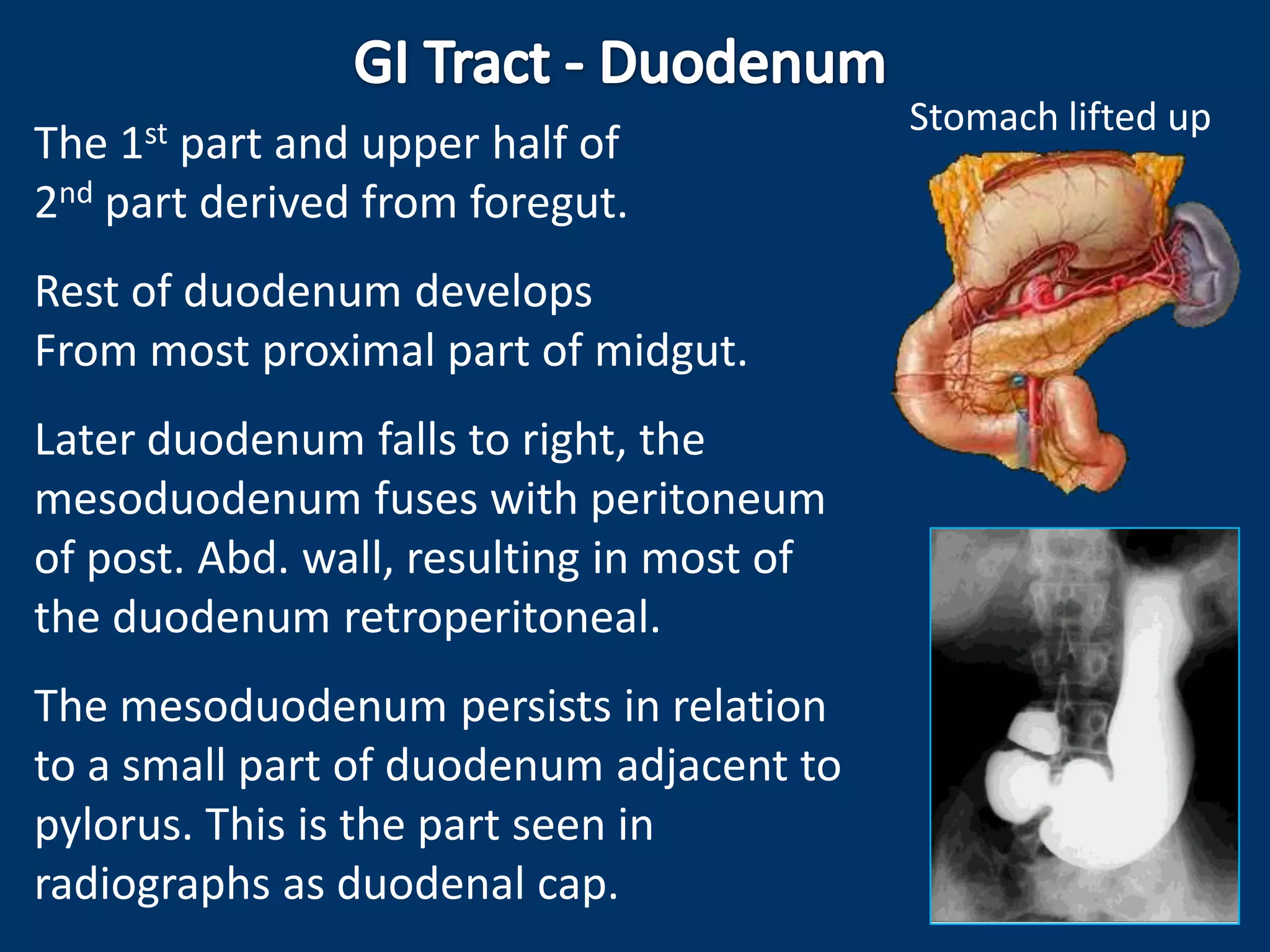 The 1st part and upper half of
2nd part derived from foregut.
Rest of duodenum develops
From most proximal part of midgut.
Later duodenum falls to right, the
mesoduodenum fuses with peritoneum
of post. Abd. wall, resulting in most of
the duodenum retroperitoneal.
The mesoduodenum persists in relation
to a small part of duodenum adjacent to
pylorus. This is the part seen in
radiographs as duodenal cap.
Stomach lifted up
 