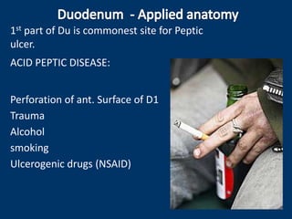 1st part of Du is commonest site for Peptic
ulcer.
ACID PEPTIC DISEASE:
Perforation of ant. Surface of D1
Trauma
Alcohol
smoking
Ulcerogenic drugs (NSAID)
 