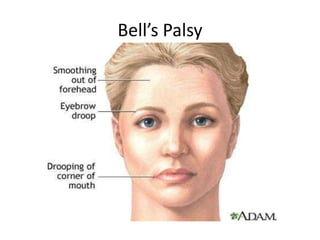 Bell’s Palsy
 