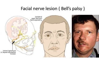 Facial nerve lesion ( Bell’s palsy )
 