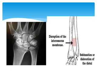 Anatomy of forearm | PPTX