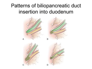 Patterns of biliopancreatic duct
insertion into duodenum
 