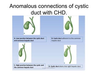 Anomalous connections of cystic
duct with CHD.
 