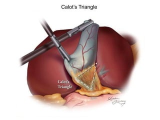 Callot Triangle Border anatomy of hepatobiliary system.pptx