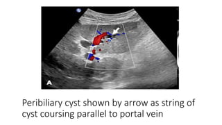 Anatomy of hepatobillary system dr avinash with cbd.pptx