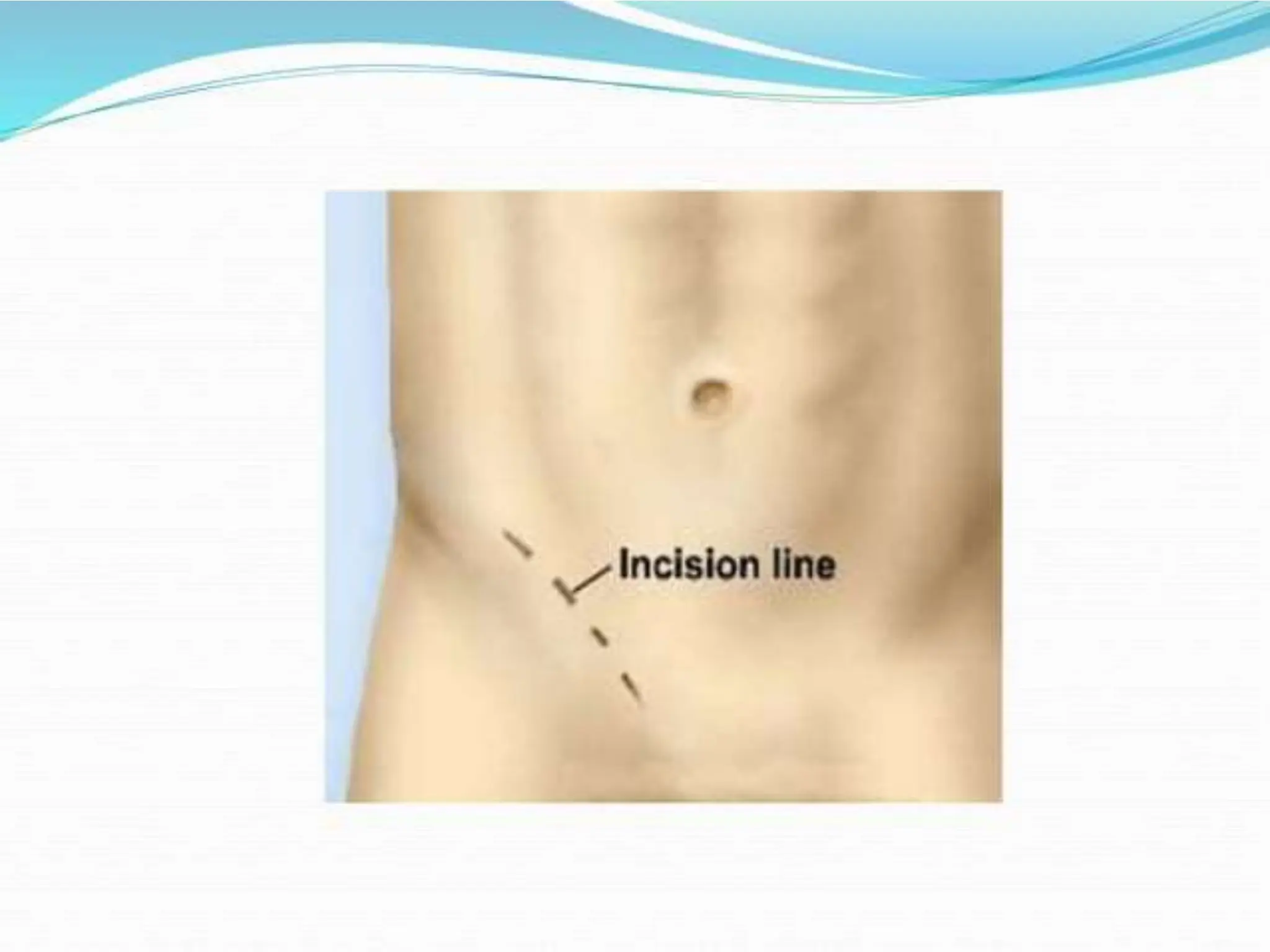 anatomy of inguinal canal and abdominal incisions | PPTX