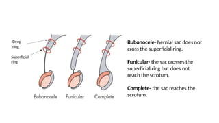 Comprehensive Overview Of Inguinal Hernia Anatomy And Types PPTX comprehensive-overview-of-inguinal-hernia-anatomy-and-types-pptx