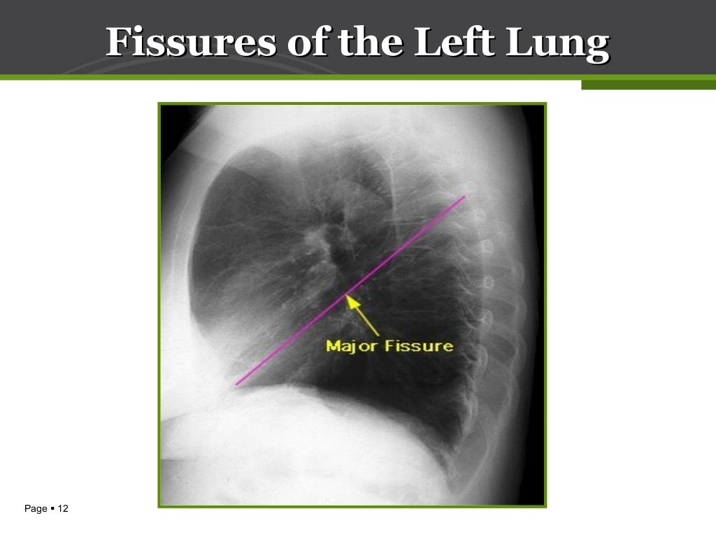 Anatomy of lung & pleura
