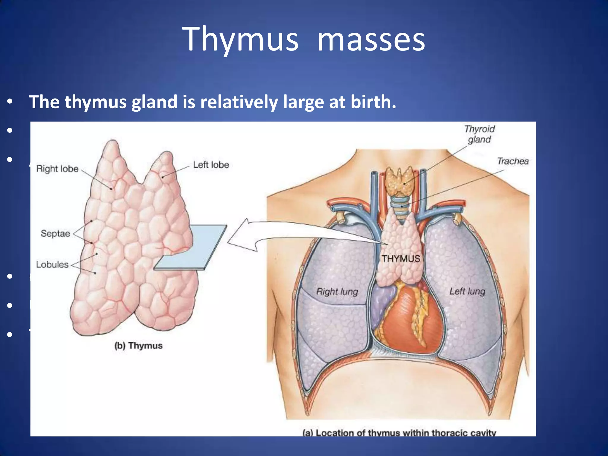 Thymus  massesThe thymus gland is relatively large at birth. After puberty, it regresses to a small size.  A  Thymic mass can be a    Tumour                                                       Cysts 					Thymic lymphoma Cysts may be single or multiple. Usually asymptomatic They manifest on chest X-ray as an enlarged thymus.