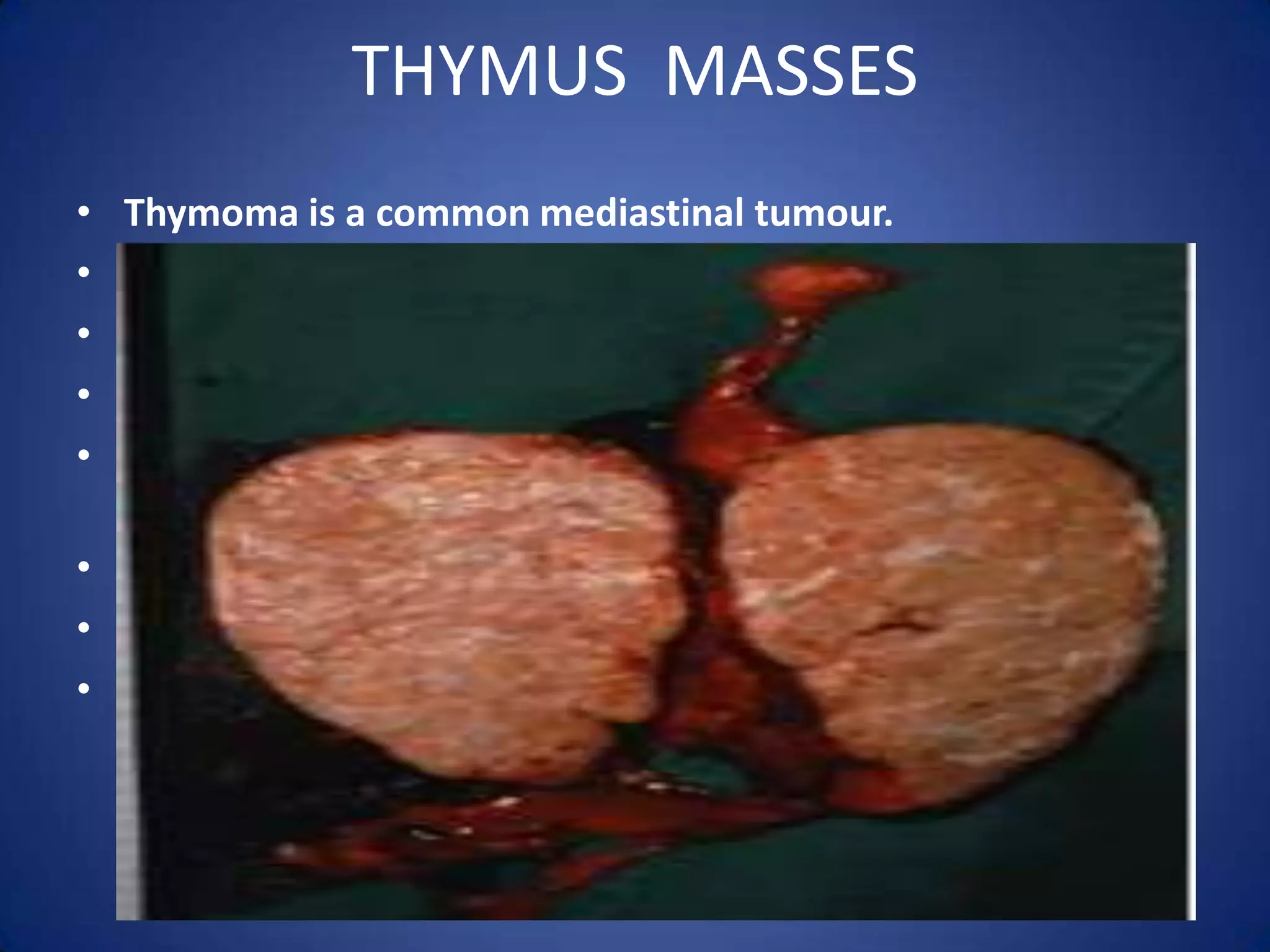 Thymus  massesThymoma is a common mediastinal tumour. It is usually malignant Usually associated with myasthenia gravis.  Some are asymptomatic. Enlarging tumours present with features of mediastinal compression syndrome Chest x-ray -Rounded shadow in the Ant. Mediastinum. Lateral view gives better delineation of the tumour. Surgical resection is the best method of treatment.