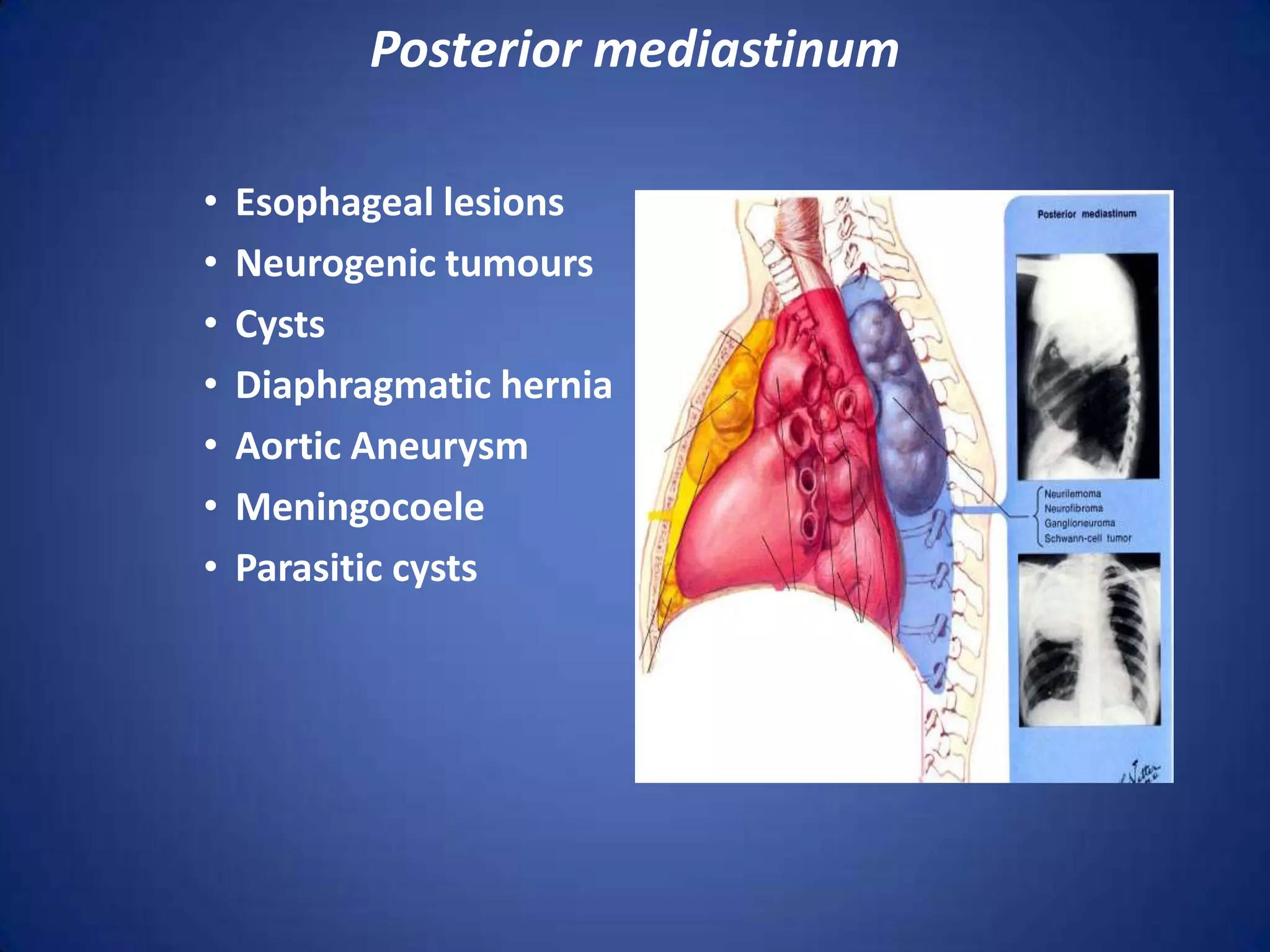 Posterior mediastinumEsophageal lesionsNeurogenic tumoursCystsDiaphragmatic herniaAortic AneurysmMeningocoeleParasitic cysts