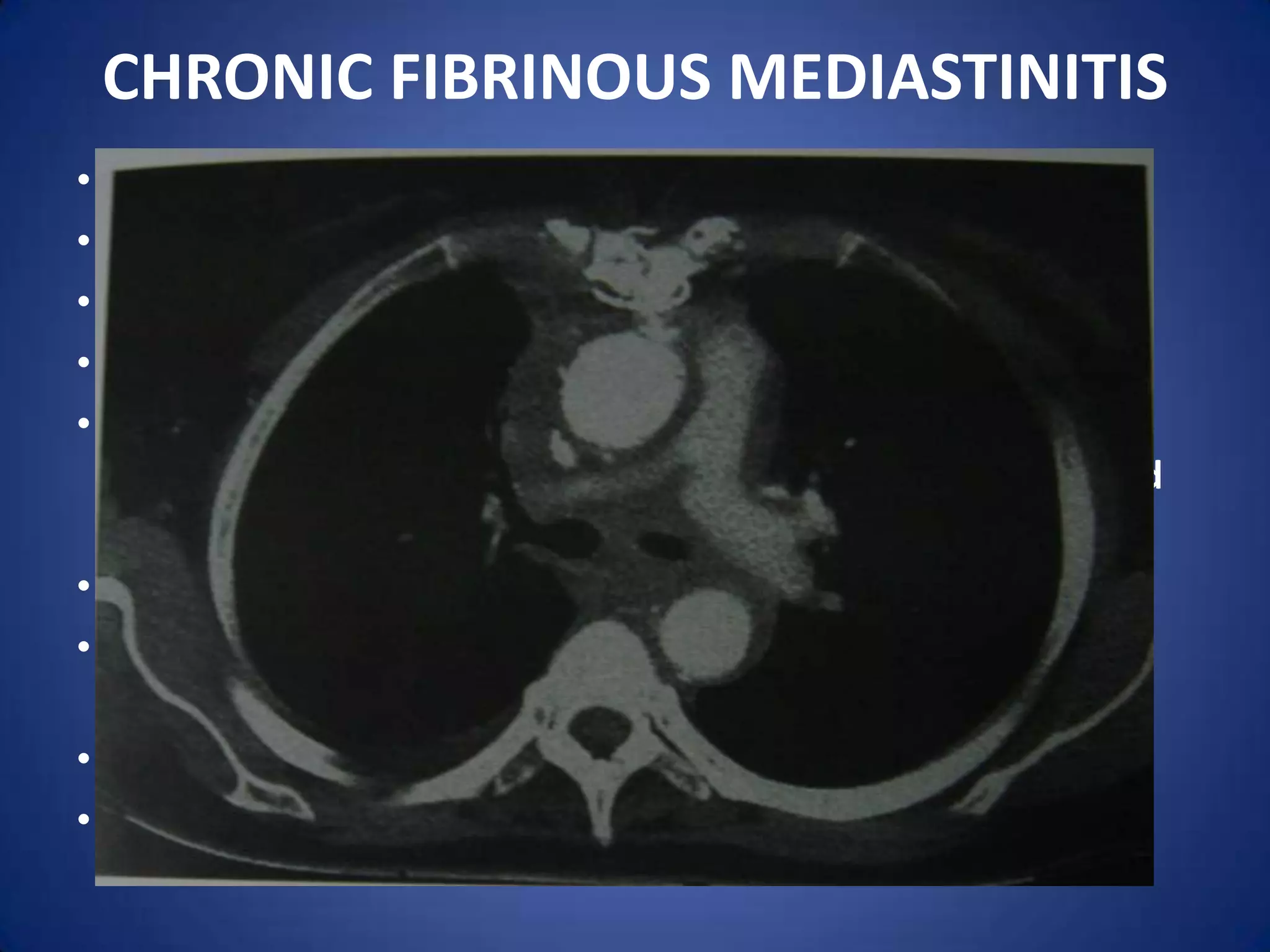 CHRONIC FIBRINOUS MEDIASTINITISIts a chronic slowly progressive fibrosis. Similar to idiopathic retroperitoneal fibrosis. Various theories have been put forward but not proven. Involves  S.V.C, Azygos and Innominate veins. Apart from engorged neck veins, swelling of face and neck, one may get headache, breathlessness, giddiness and epistaxis. X-ray chest-Widening of the upper mediastinum. Secondary causes of mediastinal fibrosis like tuberculosis and histoplasmosis must be ruled out. Corticosteroids can be tried. Surgical removal of fibrotic bands relieves the symptoms.