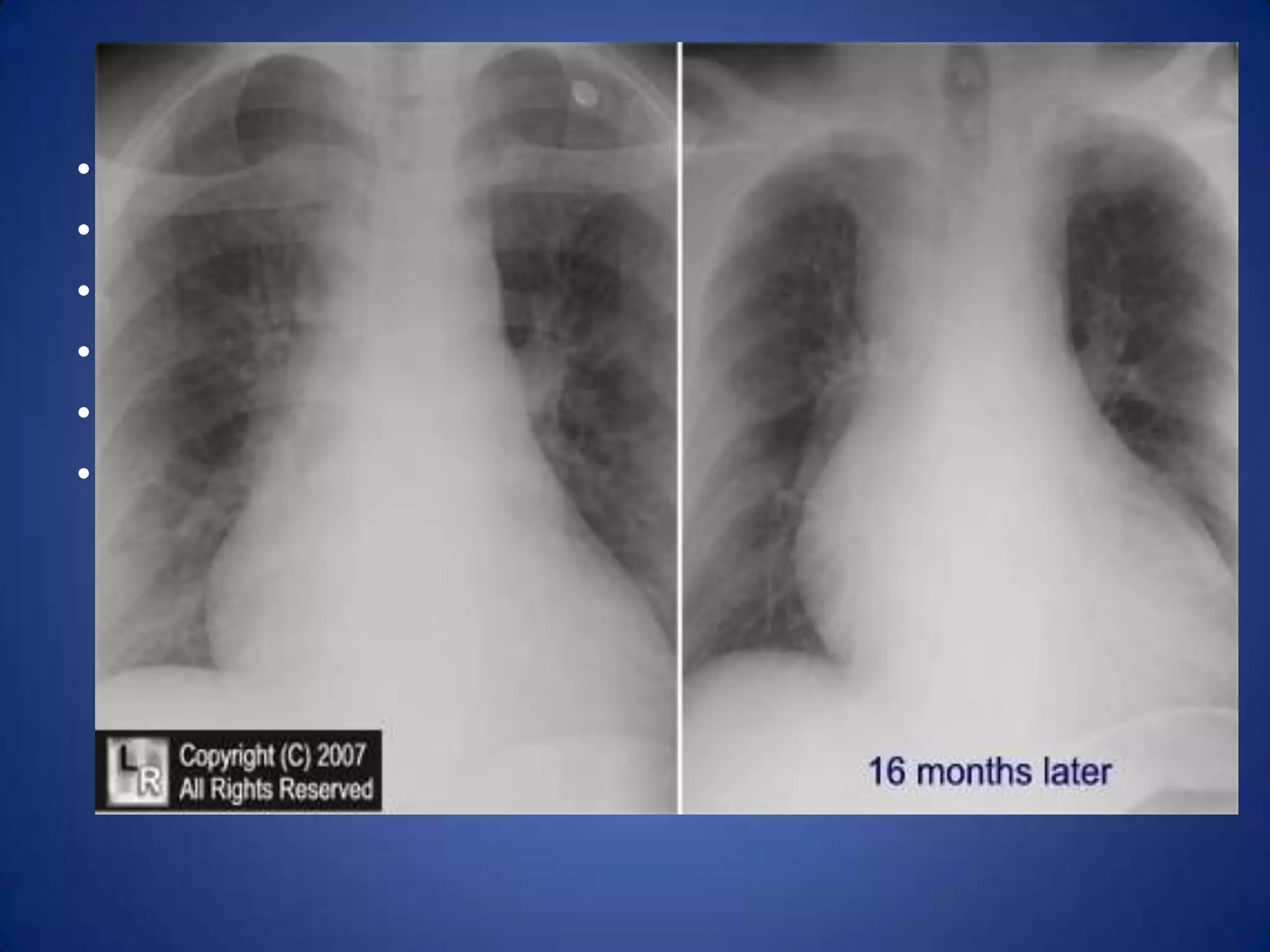 Diagnostic approach1.chest x-ray2. Computed tomography (CT) –3. Magnetic resonance imaging-For spinal tumours.4.Fine-needle aspiration biopsy – valuable .5. Anterior mediastinotomy.6. Bronchoscopy –limited value