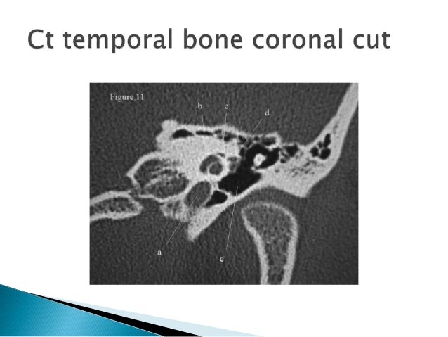 Anatomy of middle ear