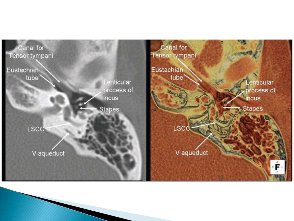 Anatomy of middle ear