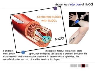 Extravascular Injection Anatomy of NaOCl accidents involving facial ecchymosis.pptx